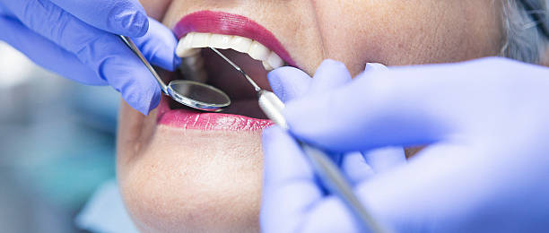 Best Emergency Dental Care for Broken or Chipped Teeth in Brockport, NY